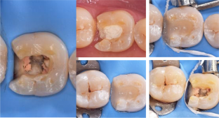 Biological evaluation of indirect restorations in endodontically