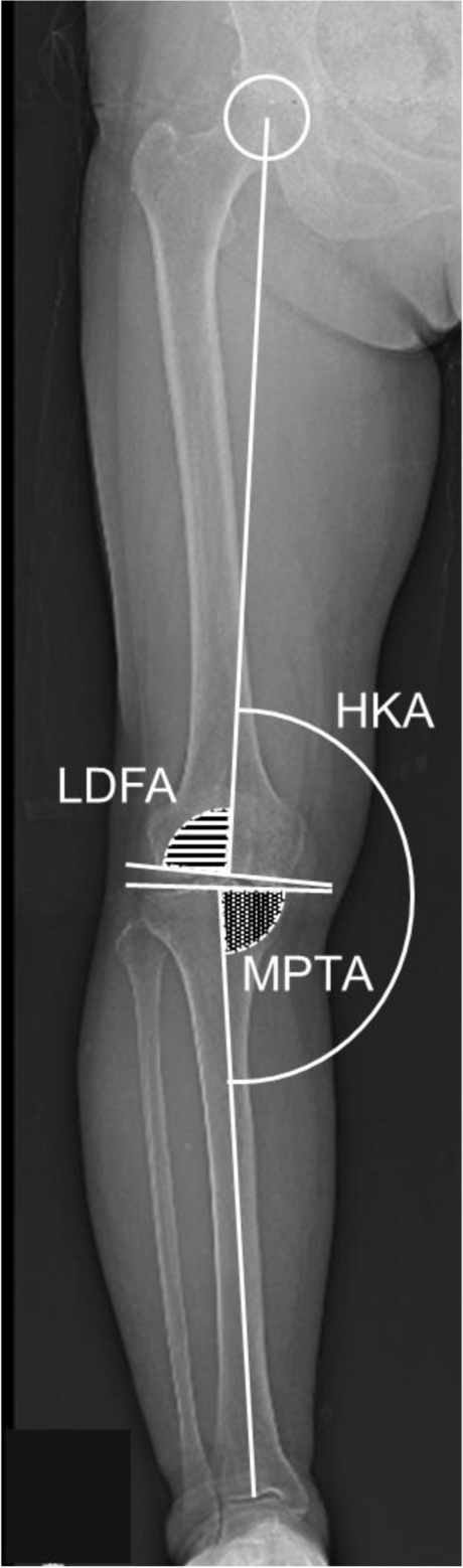 Predicting postoperative coronal alignment after fixed-bearing