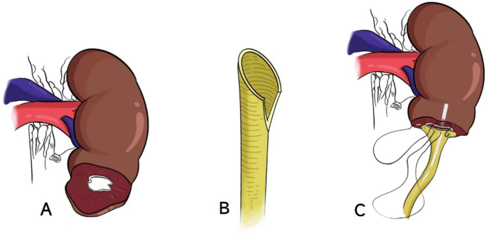 Ureterocalicostomy for complex upper ureteral stricture: a narrative ...