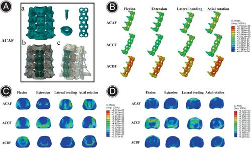 Biomechanical Comparison of Anterior Cervical Corpectomy Decompression ...