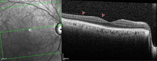 Epiretinal membrane development after Ex-Press glaucoma filtration ...