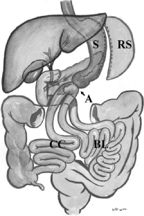 Single Anastomosis Duodeno-Ileal bypass (SADI-S) as Primary or Two ...