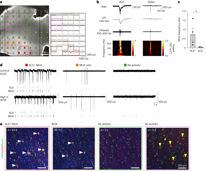 Targeting pathological cells with senolytic drugs reduces seizures in ...