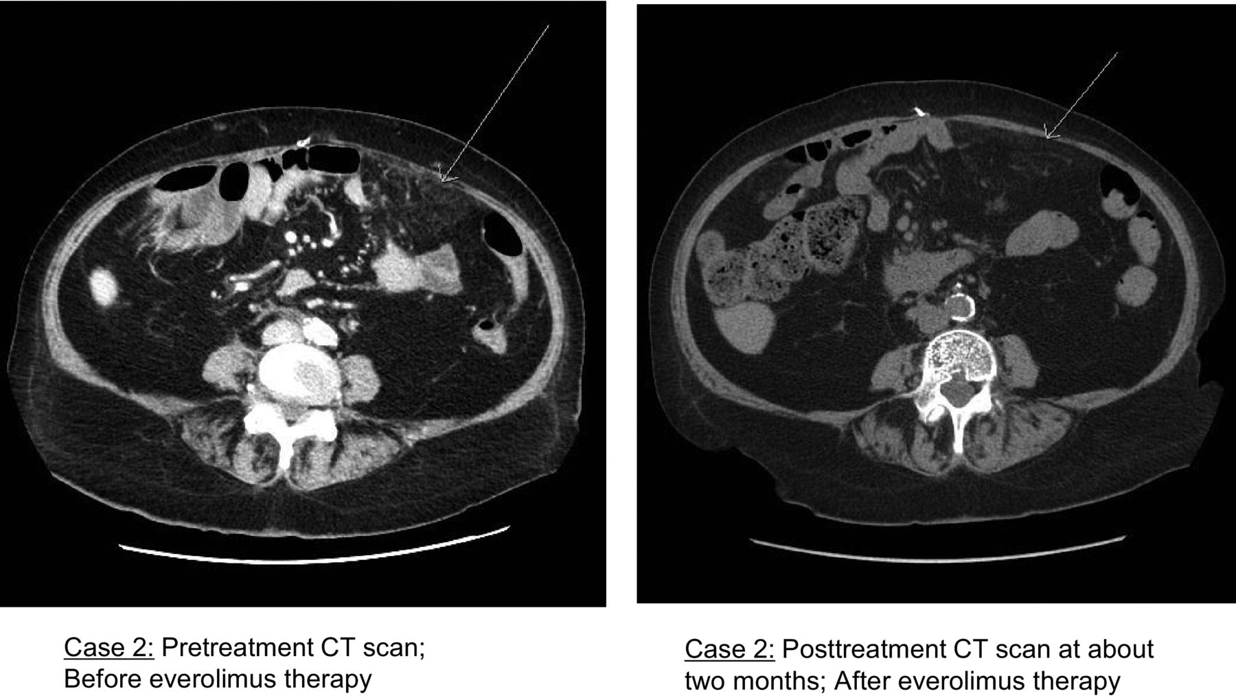 Cell Free DNA From Ascites And Pleural Effusions Molecular Insights Cell free dna from ascites and pleural effusions molecular insights