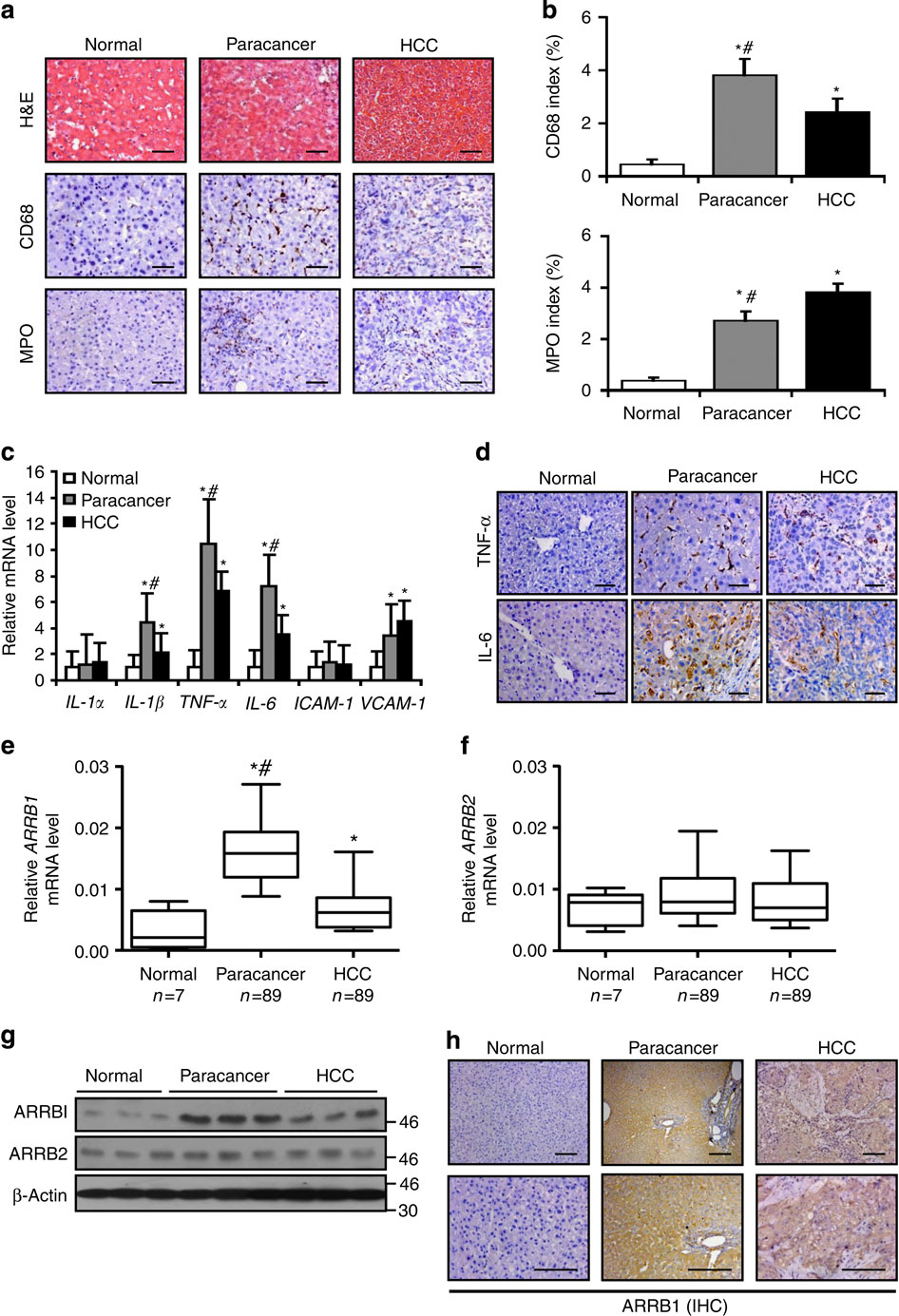 Arrestin Enhances Hepatocellular Carcinogenesis Through Inflammation Mediated Akt Signalling