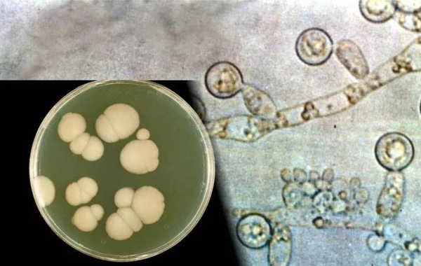 口腔潰瘍的真菌還和阿爾茨海默病有關科學家發現常見白色念珠菌竟可